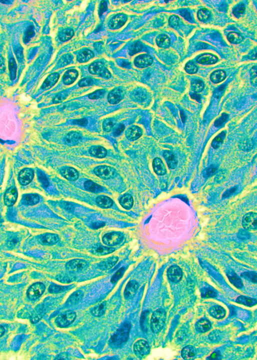 Vet Artwork - Images of Pituitary Adenoma cells in a horse.