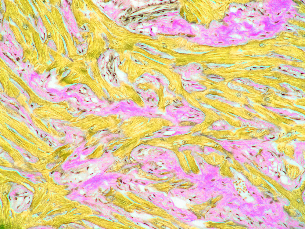 Vet Artwork - Image of hypertrophic cardiomyopathy trichrome stain