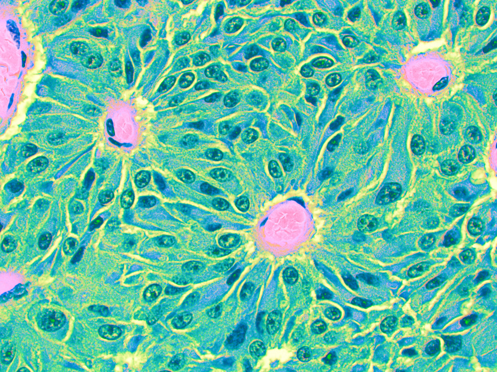 Vet Artwork - Images of Pituitary Adenoma cells in a horse.